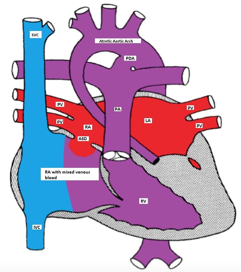 Hypoplastic left heart